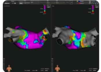 مستشفى سهلول: نجاح أول عملية لاستئصال اضطرابات نبضات القلب بتقنية متطورة