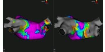 مستشفى سهلول: نجاح أول عملية لاستئصال اضطرابات نبضات القلب بتقنية متطورة