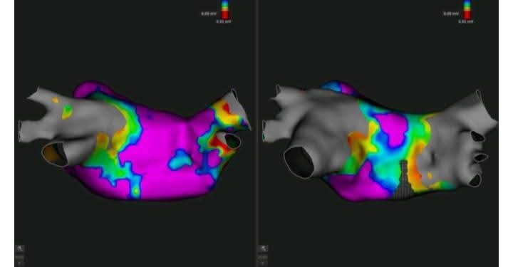 مستشفى سهلول: نجاح أول عملية لاستئصال اضطرابات نبضات القلب بتقنية متطورة