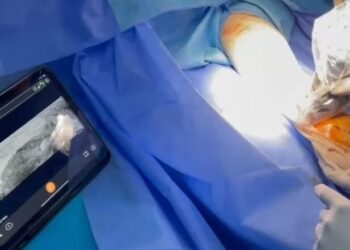 دون الحاجة إلى تخدير: إجراء أول عملية جراحية بالموجات فوق الصوتية في تونس