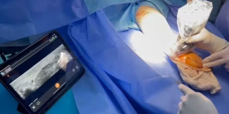 دون الحاجة إلى تخدير: إجراء أول عملية جراحية بالموجات فوق الصوتية في تونس